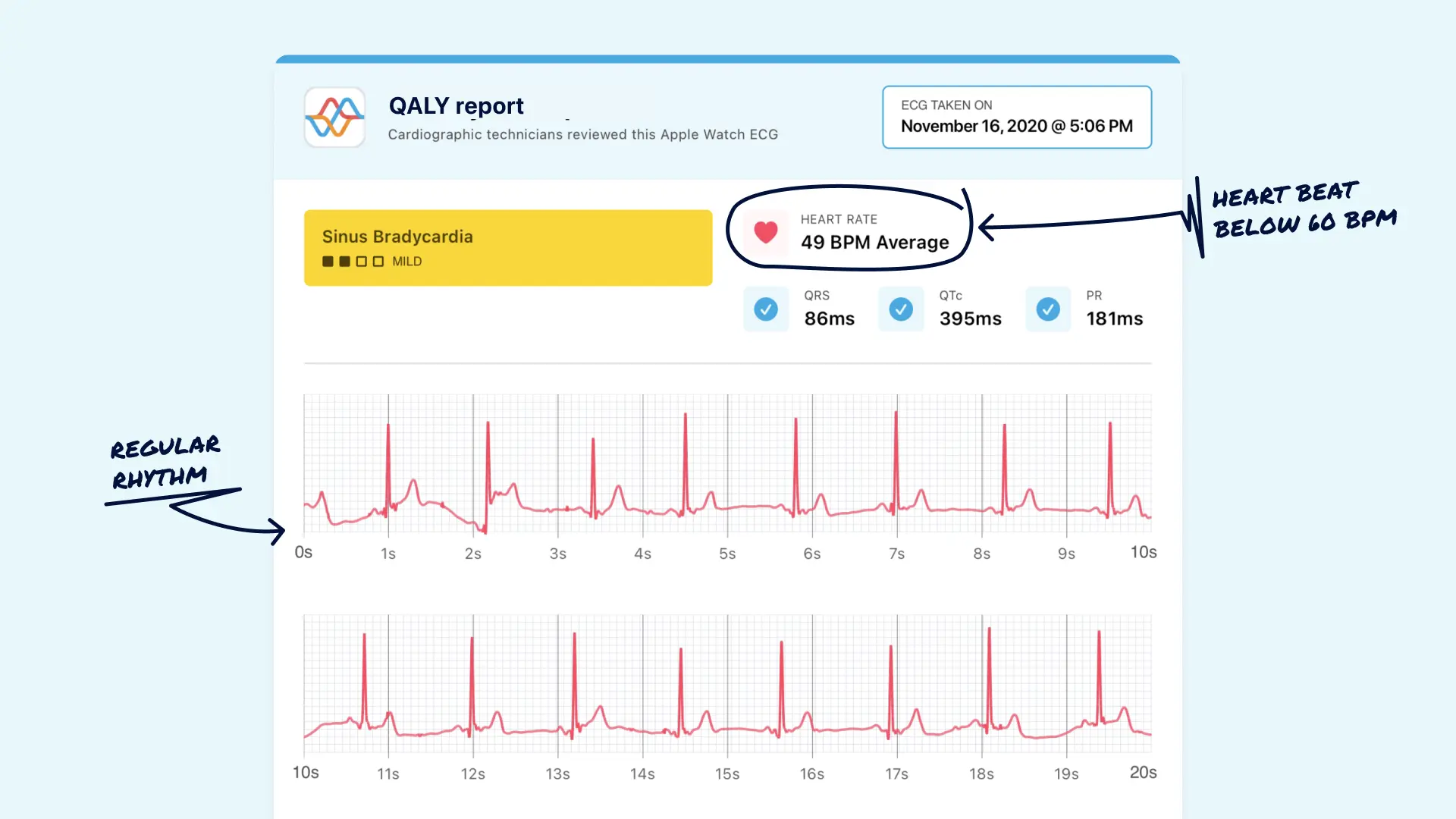 What Sinus Bradycardia Looks Like on Your Watch ECG Qaly